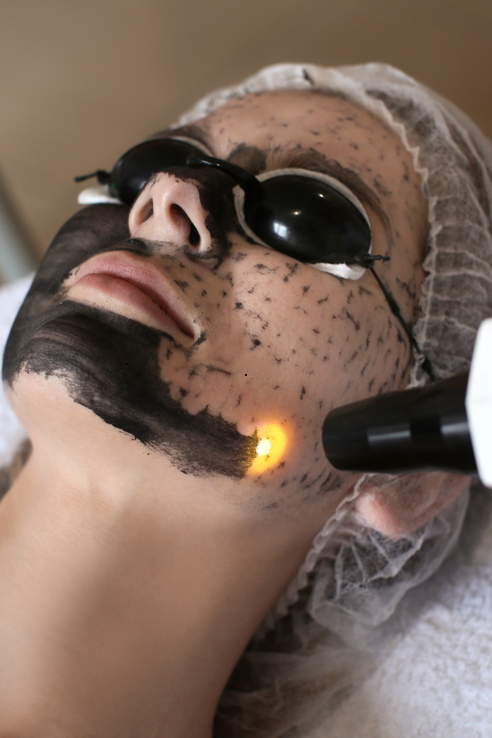 Carbon Facial