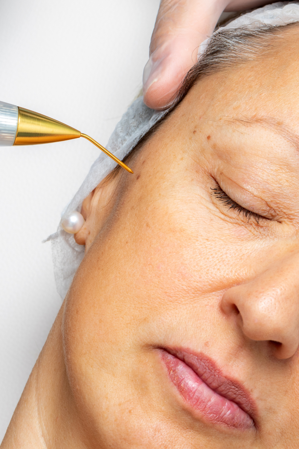 Fibroblast Treatment
